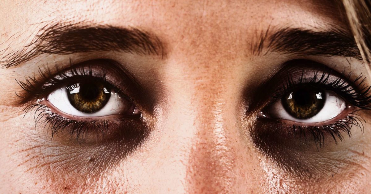 What Causes Bags and Dark Circles Under Eyes?